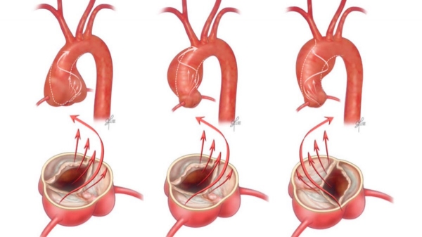 Enlarged Aortic Root Here Are The Causes Industry Global News24